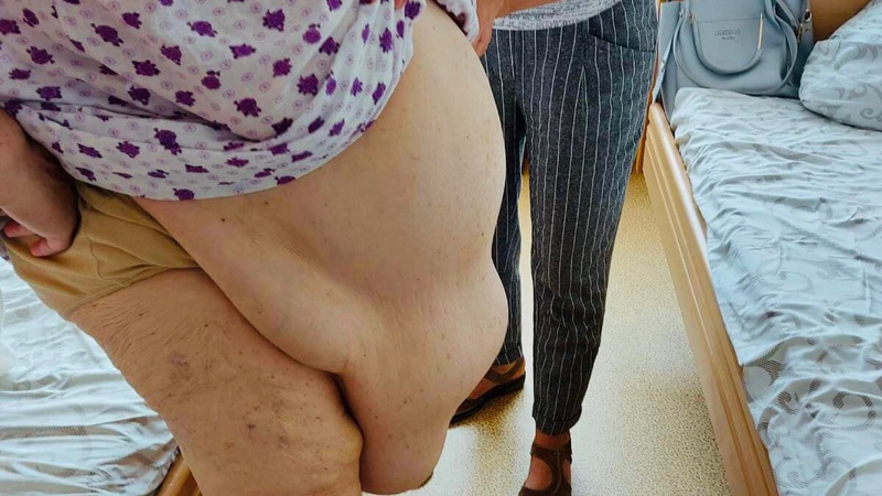 Терпіла більше 10 років: волинянці видалили понад 15 кілограмів жиру