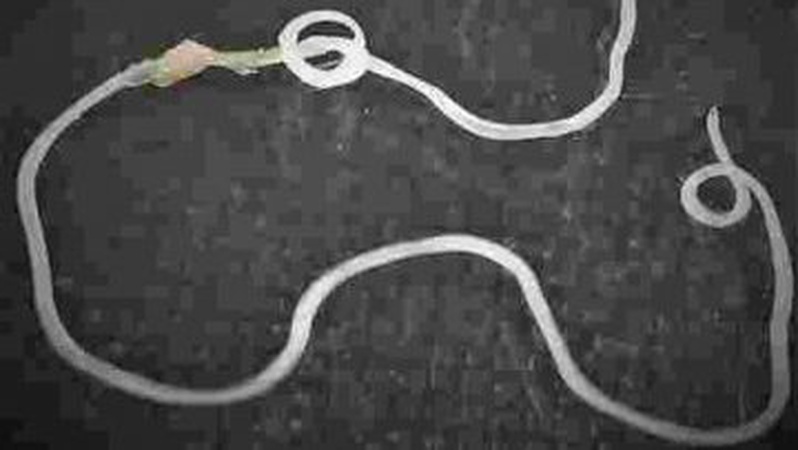 З тіла волинянки медики дістали 20-сантиметрового гельмінта