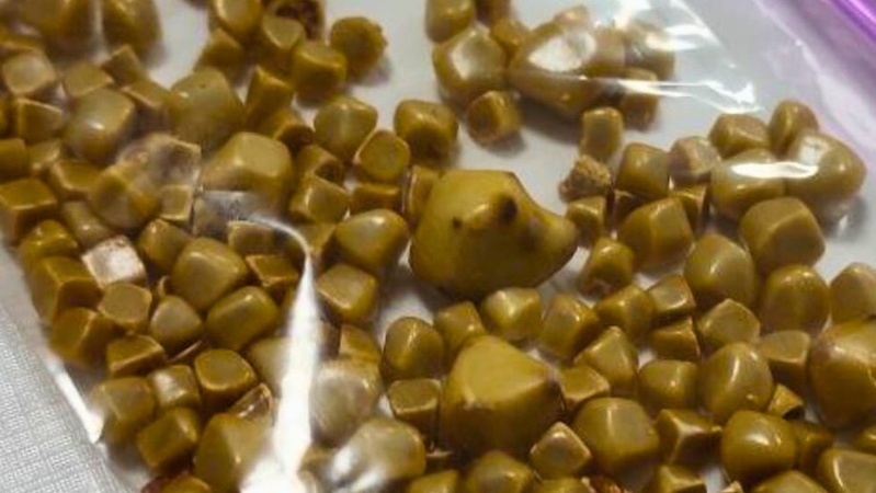 Волинські медики видалили пацієнтці жовчний міхур із понад сотнею камінців