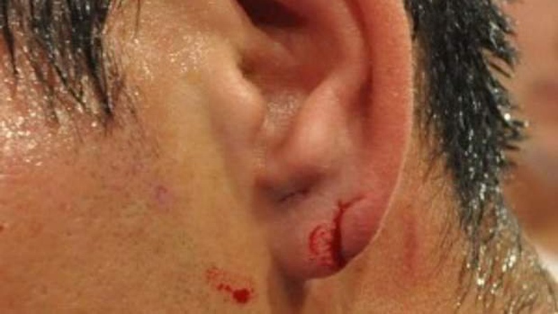 На Волині судили чоловіка, який під час бійки вкусив за вухо школяра