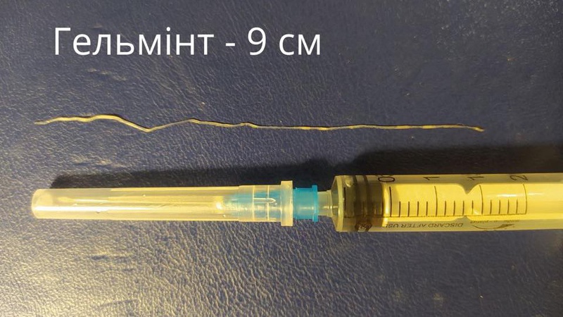 З ока волинянки дістали 9-сантиметрового гельмінта. ФОТО