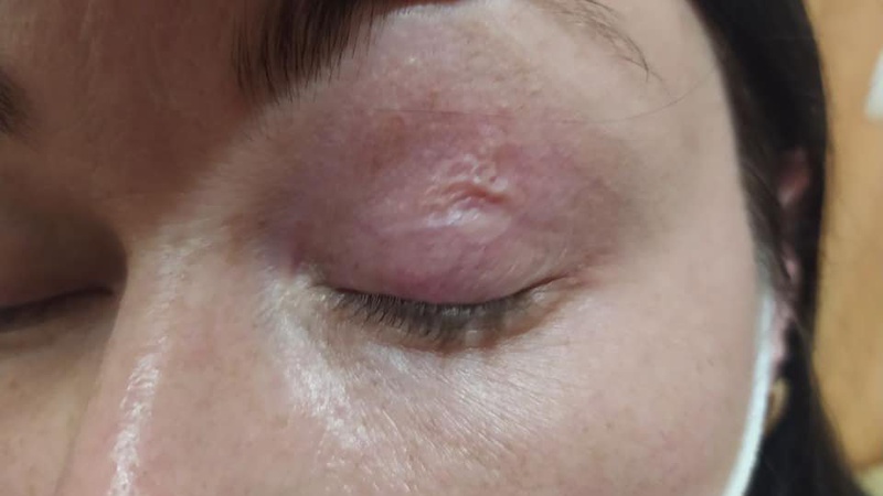 Із повіки волинянки видалили гельмінта: в області зареєстрували 2-й випадок дирофіляріозу