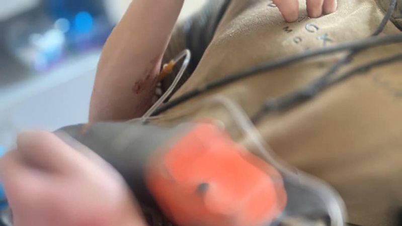 У Нововолинську чоловіку застрягла в передпліччі електропила