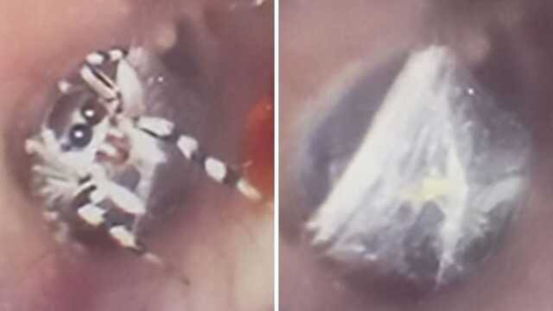 Жив там тиждень: павук заліз у вухо рівнянки та сплів у ньому павутину