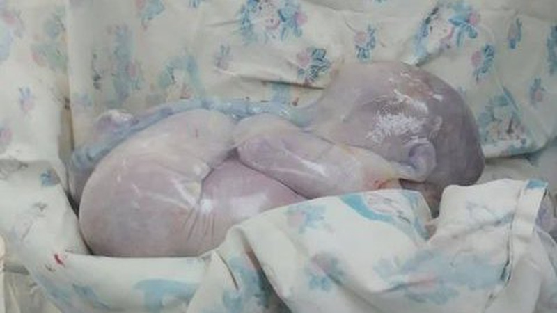 Народжені «у сорочках»: у Рівному запровадили особливу методику пологів