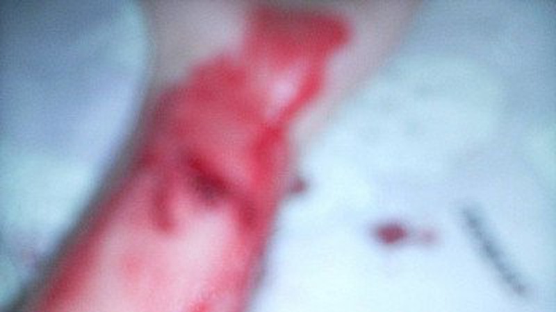 У Луцьку чоловік впав на розбиту пляшку й стікав кров’ю