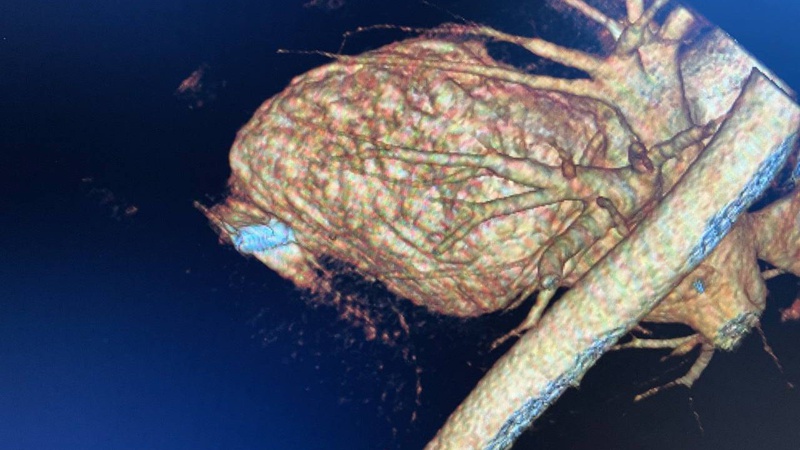 У «Феофанії» військовослужбовцю ЗСУ провели унікальну операцію