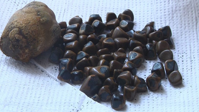 У Луцьку хірурги видалили пацієнтці понад 80 каменів з жовчного міхура