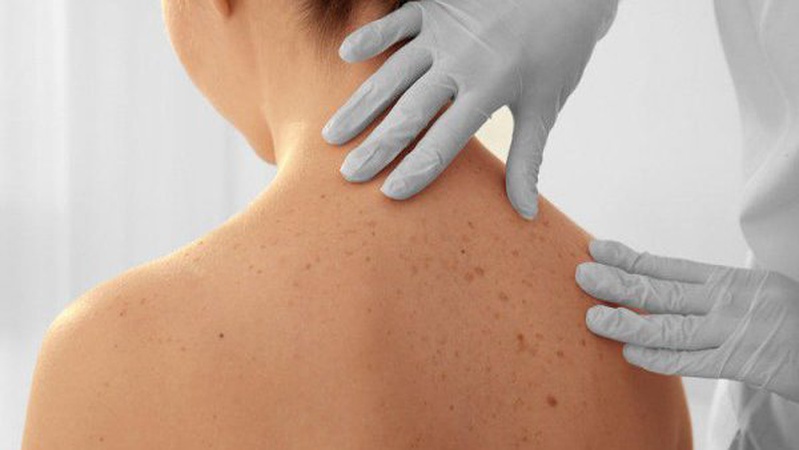 У Луцьку безоплатно обстежуватимуть дорослих та підлітків на рак шкіри