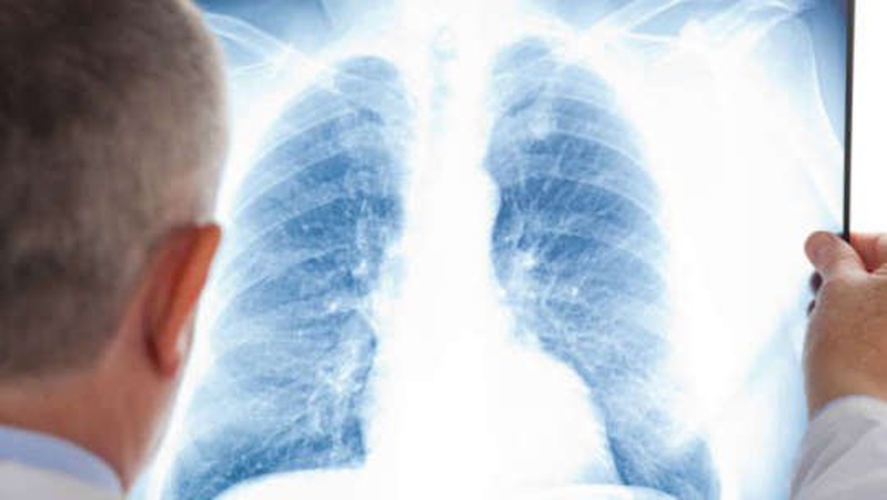 Пневмонія після COVID-19: лікар назвав симптоми та розповів, що робити