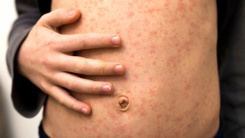 Вперше за три роки на Волині зафіксували випадок кору у підлітка