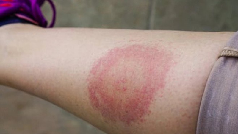 Волиняни почали більше хворіти на лаймбореліоз