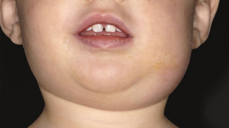 На Волині спалах епідемічного паротиту