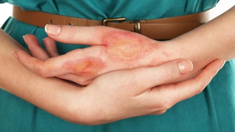 На Волині жінка обпекла собі ноги та живіт: деталі