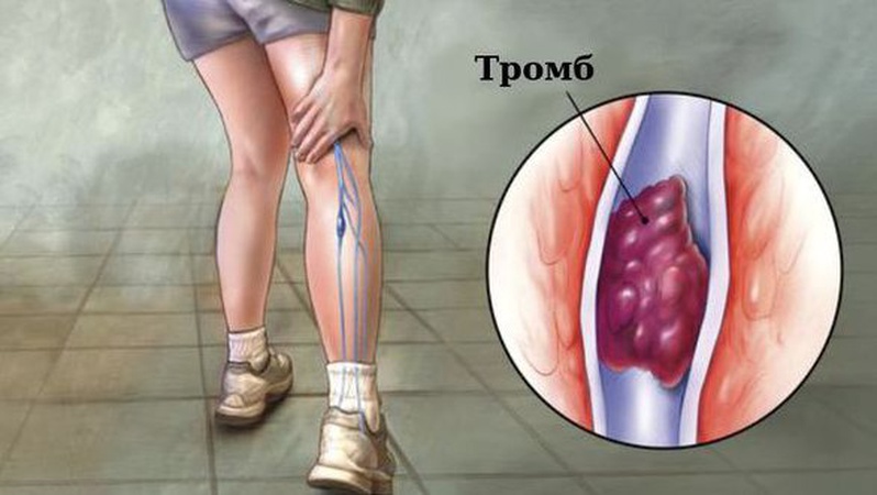 Чи можна вакцинуватися при варикозі й не боятися тромбозу? Відповіли луцькі флеболог і кардіолог