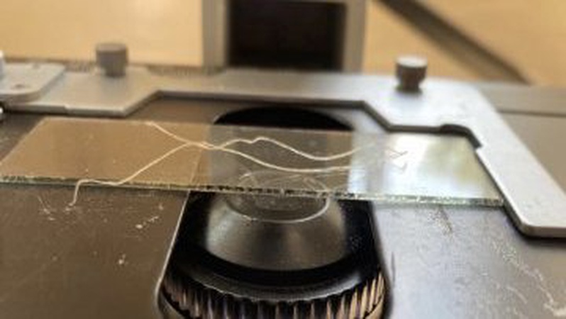 На Волині – новий випадок дирофіляріозу: з ока жінки витягнули 11-сантиметрового гельмінта