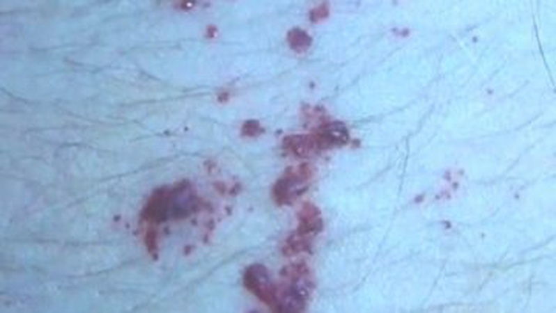 Хвороба Фабрі: на Волині виявили рідкісну і небезпечну хворобу