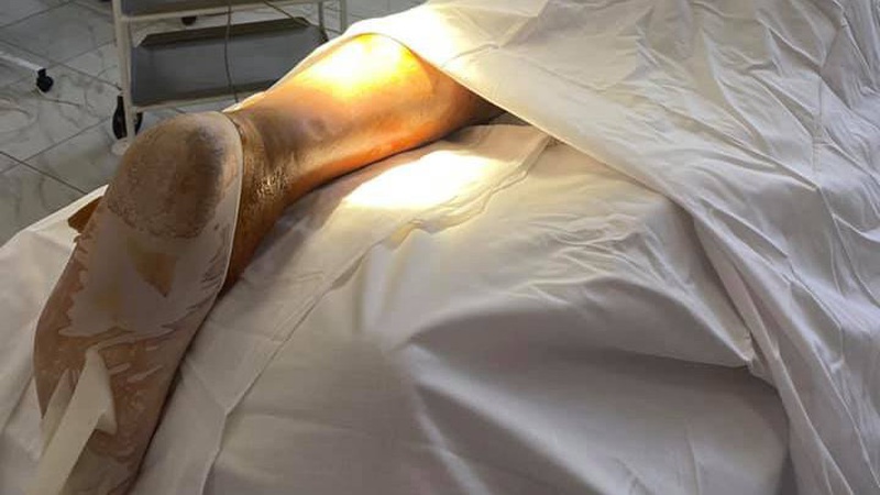 Прооперували волинянина, який розірвав ахіллове сухожилля. Фото 18+