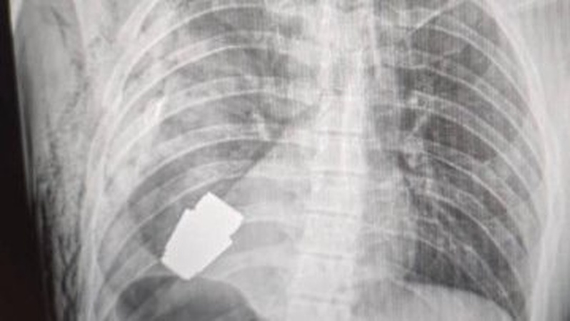 Героїчна операція: з тіла військовослужбовця дістали гранату, яка не розірвалася