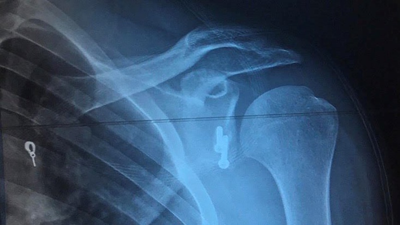 Волинські лікарі прооперували військового з численними вивихами плеча