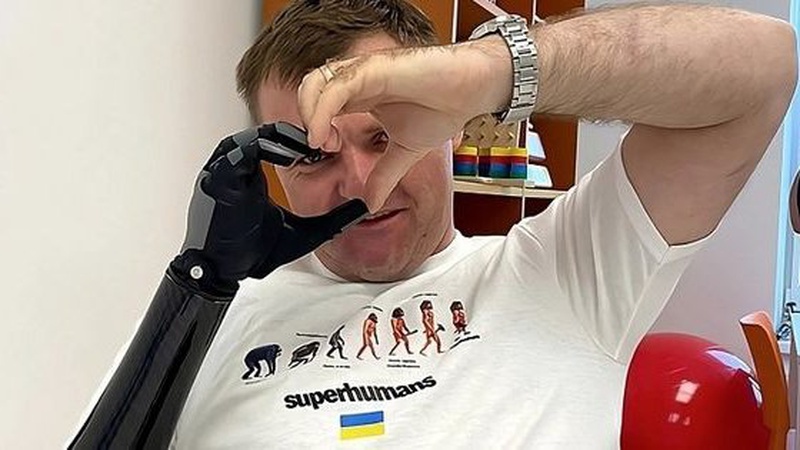 «Після перемоги Михайло мріє відбудовувати Україну»: воїну з Волині встановили сучасний біонічний протез руки