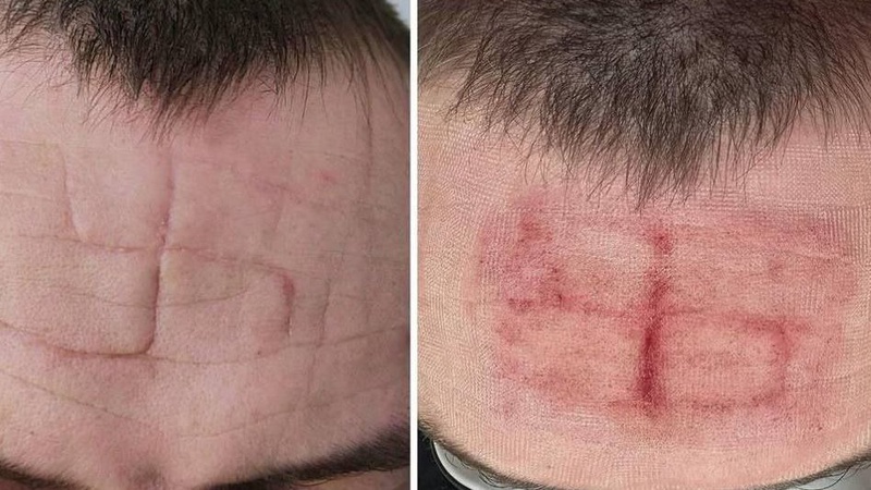 Вирізали свастику на лобі: як окупанти знущалися над полоненим військовим